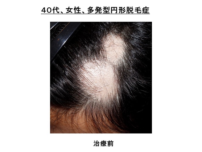 円形脱毛症　病院